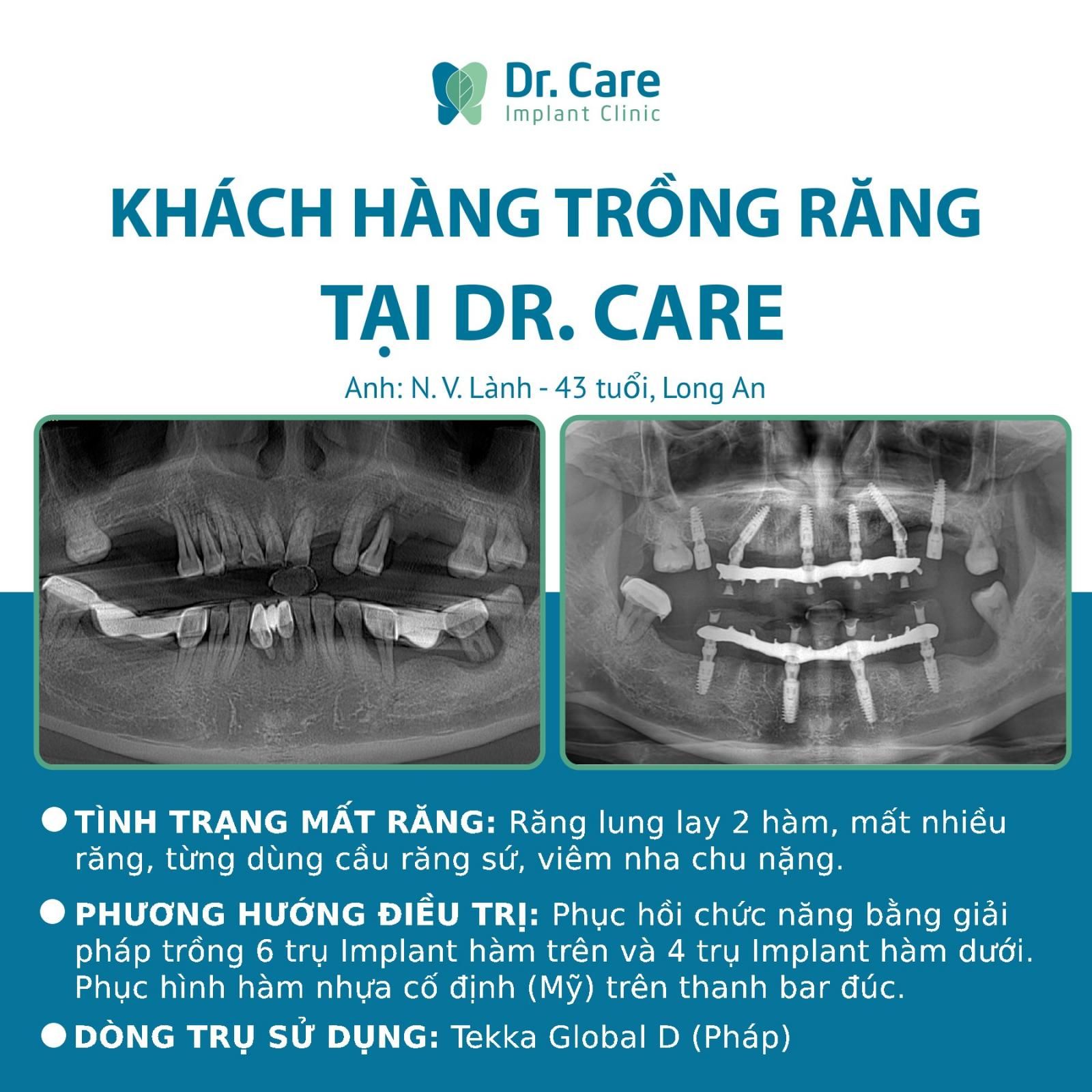 Nhật ký trồng răng Implant