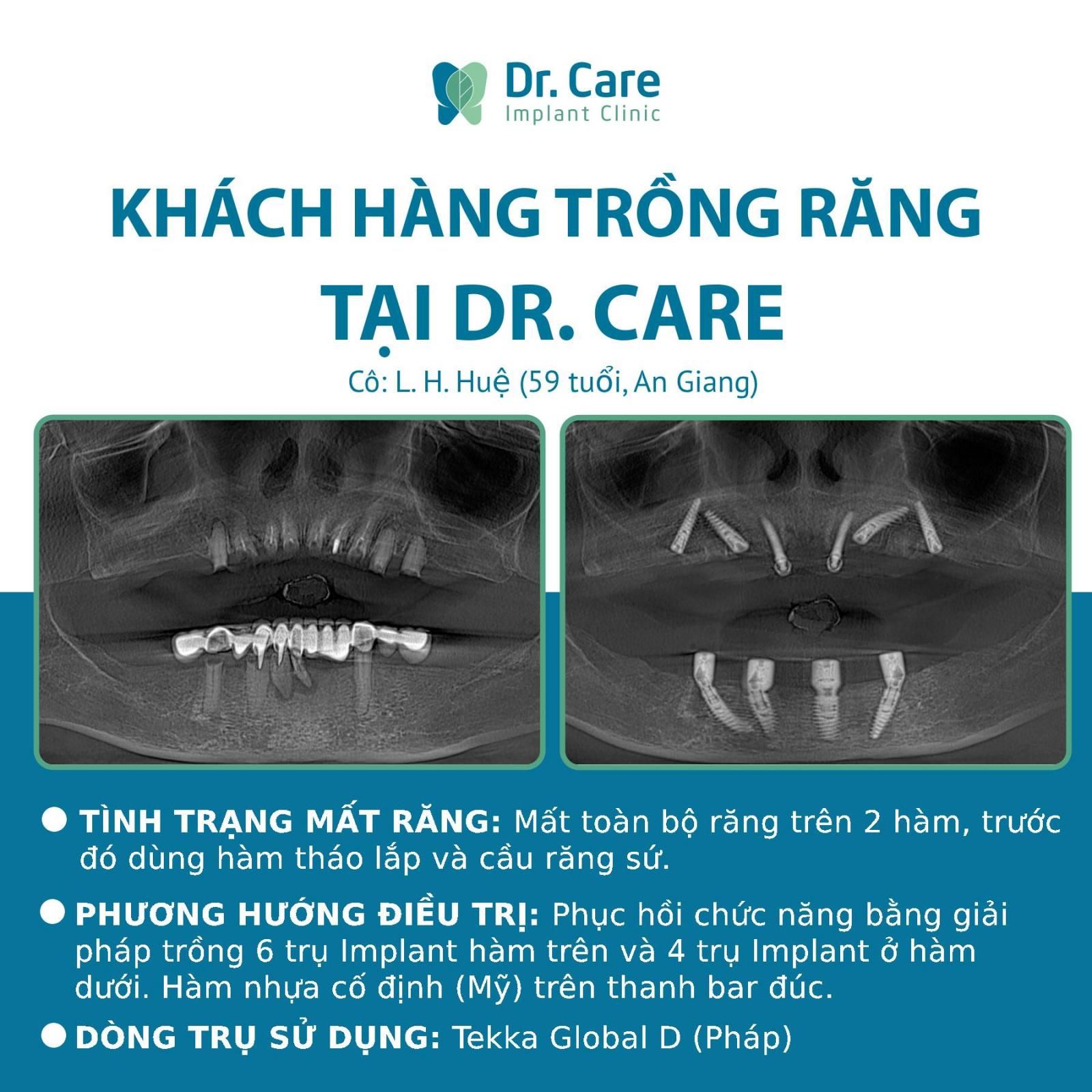 Nhật ký trồng răng Implant