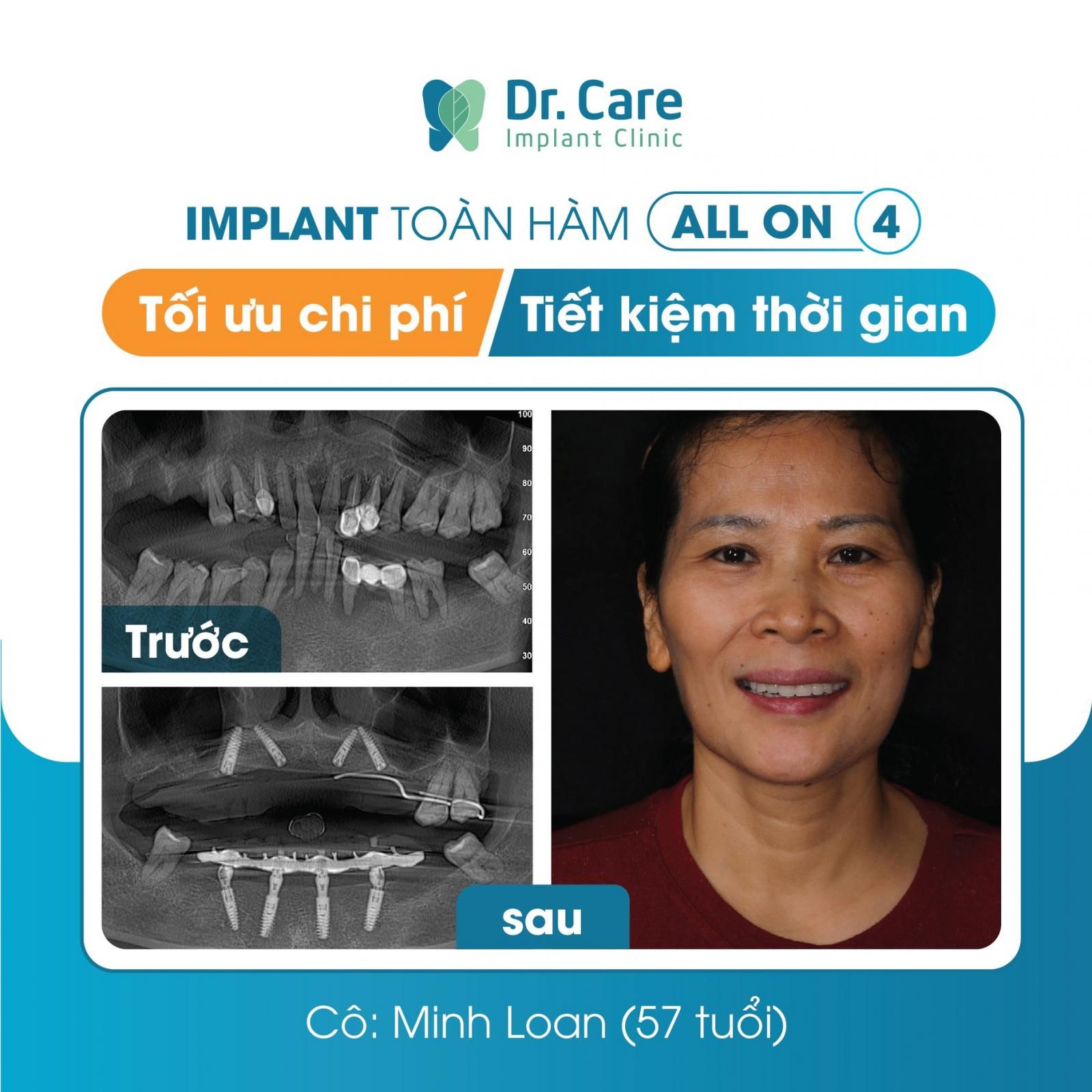 Nhật ký trồng răng Implant