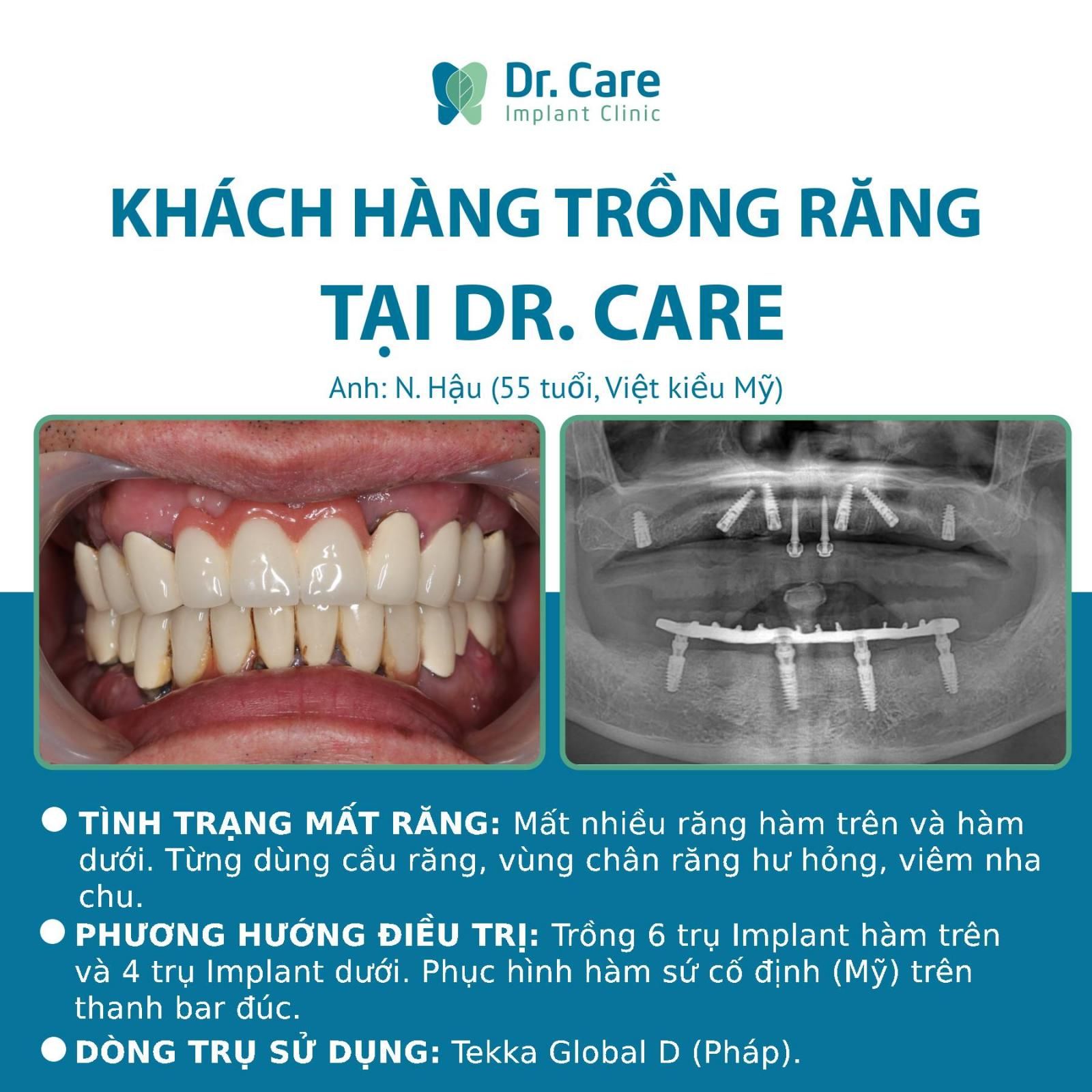 Nhật ký trồng răng Implant