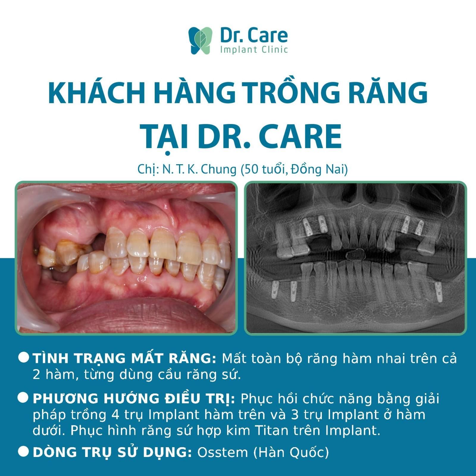 Nhật ký trồng răng Implant