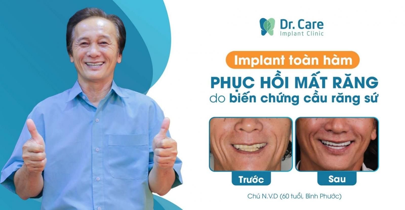 Nhật ký trồng răng Implant