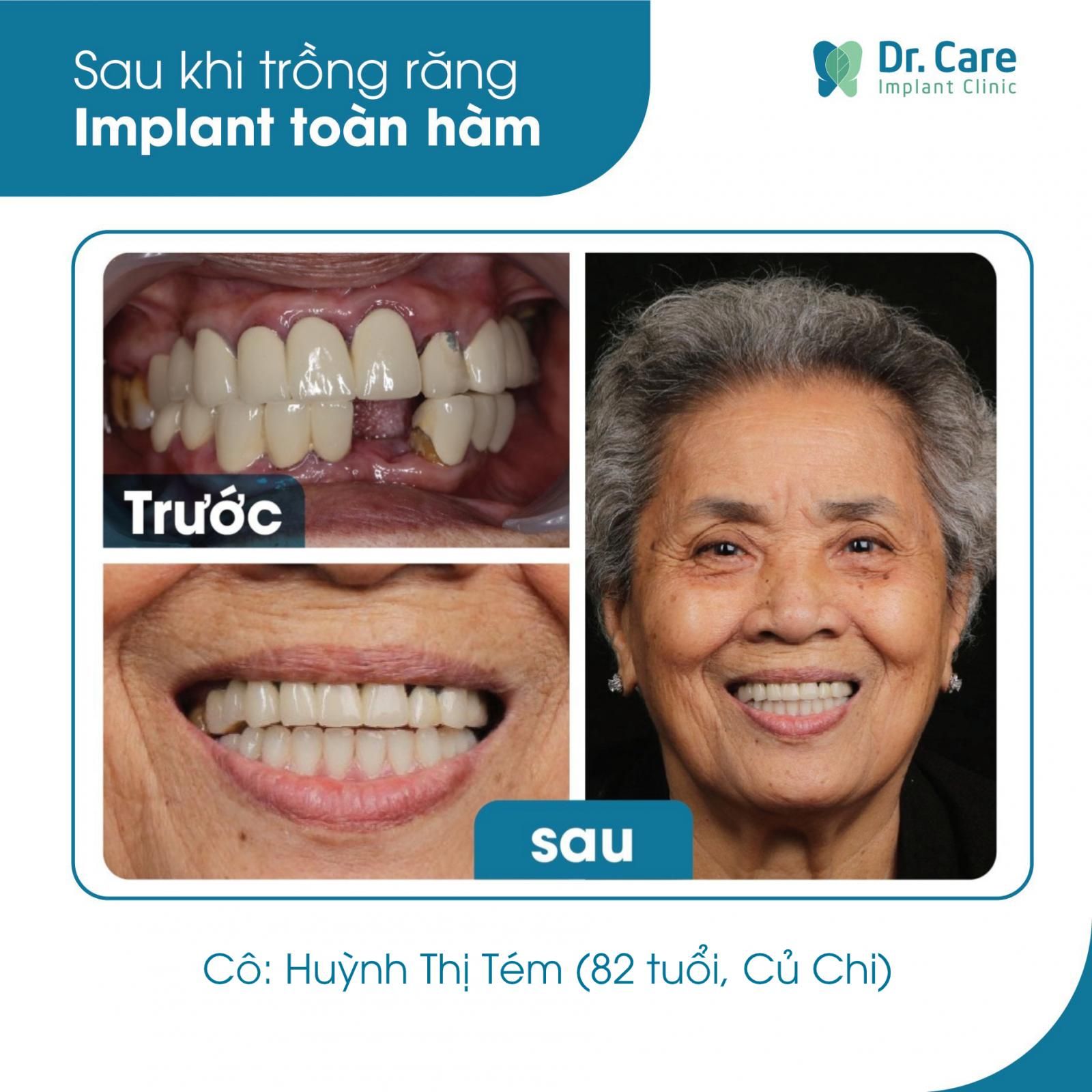 Nhật ký trồng răng Implant