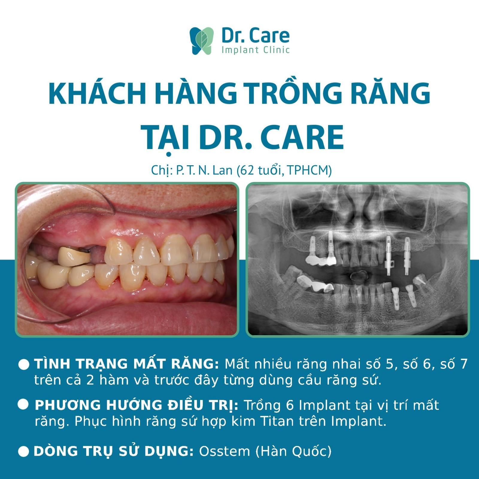 Nhật ký trồng răng Implant