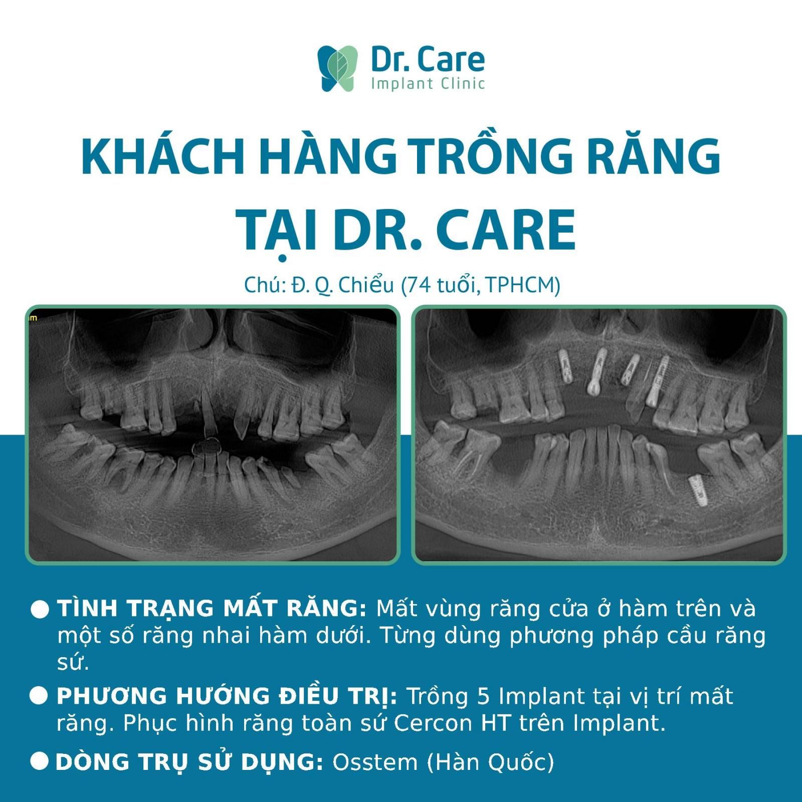 Nhật ký trồng răng Implant