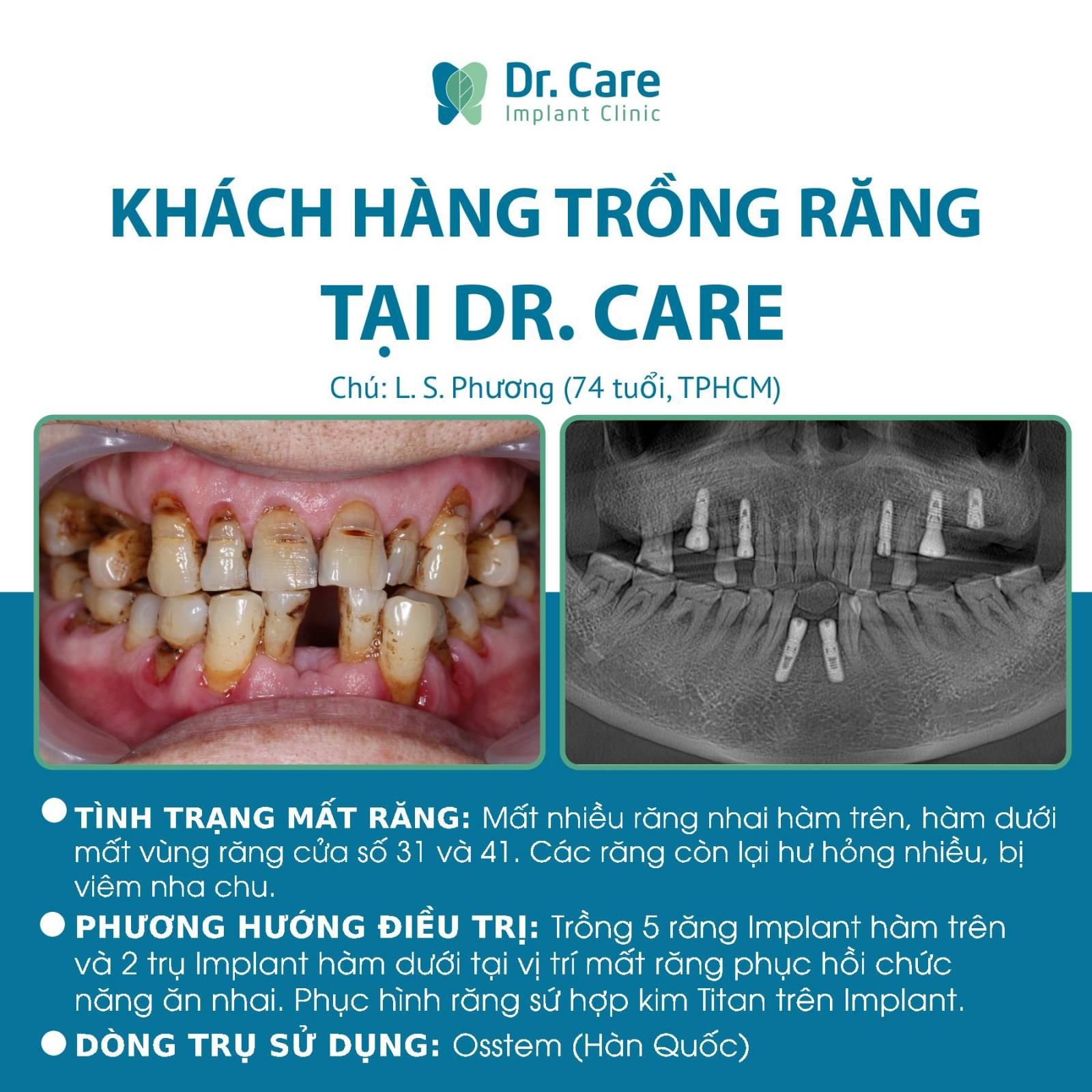 Nhật ký trồng răng Implant