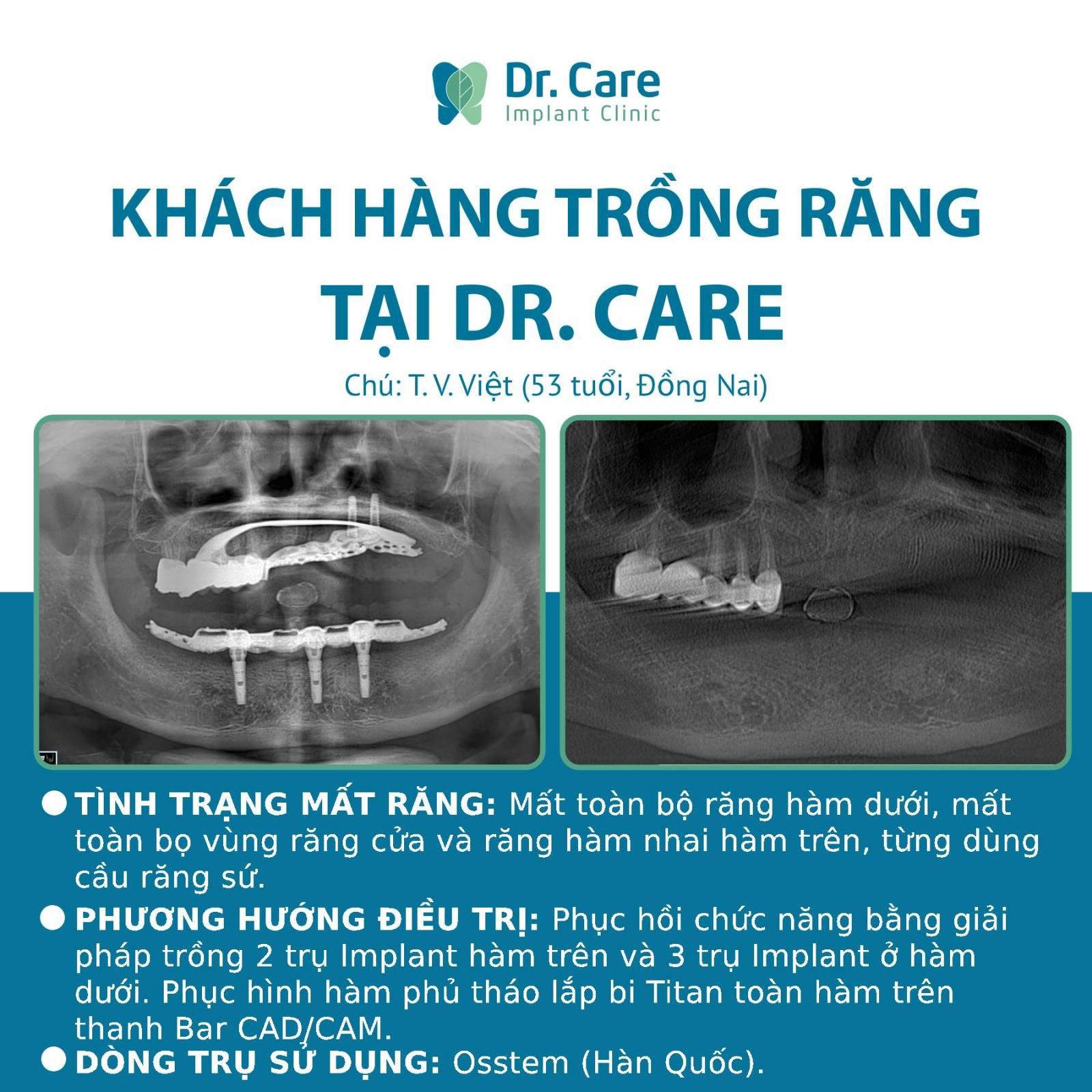 Nhật ký trồng răng Implant