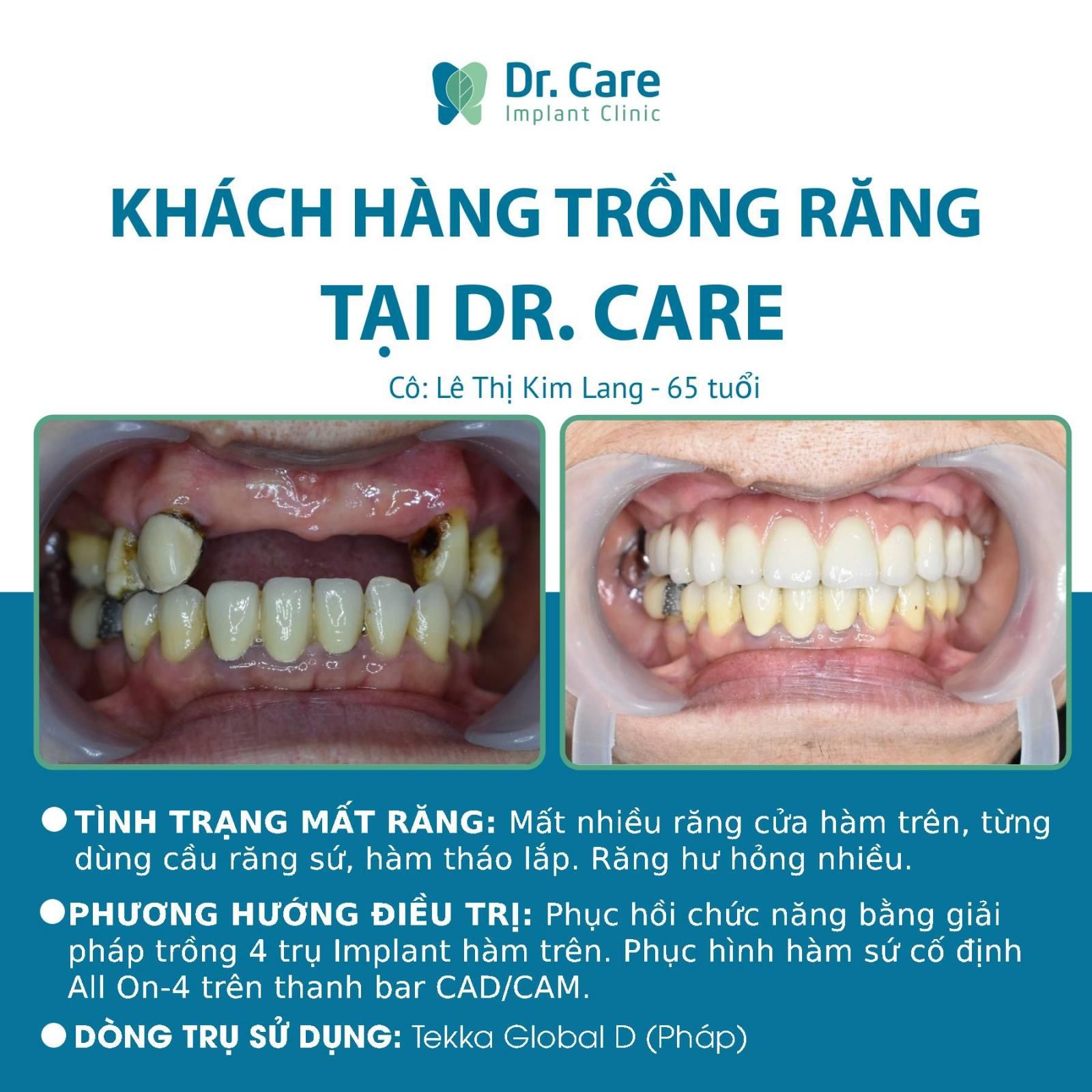 Nhật ký trồng răng Implant