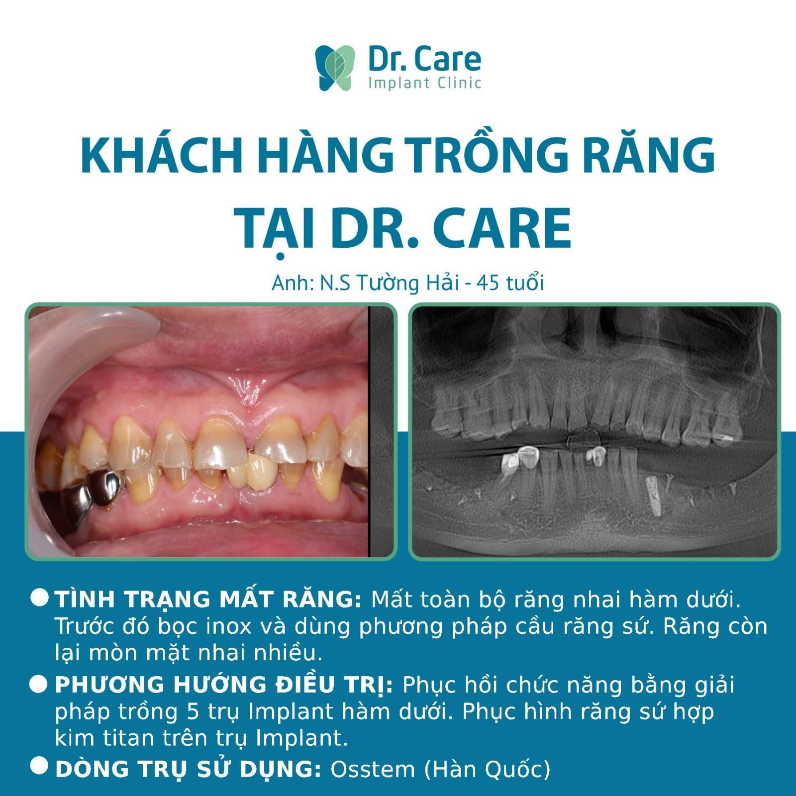 Nhật ký trồng răng Implant