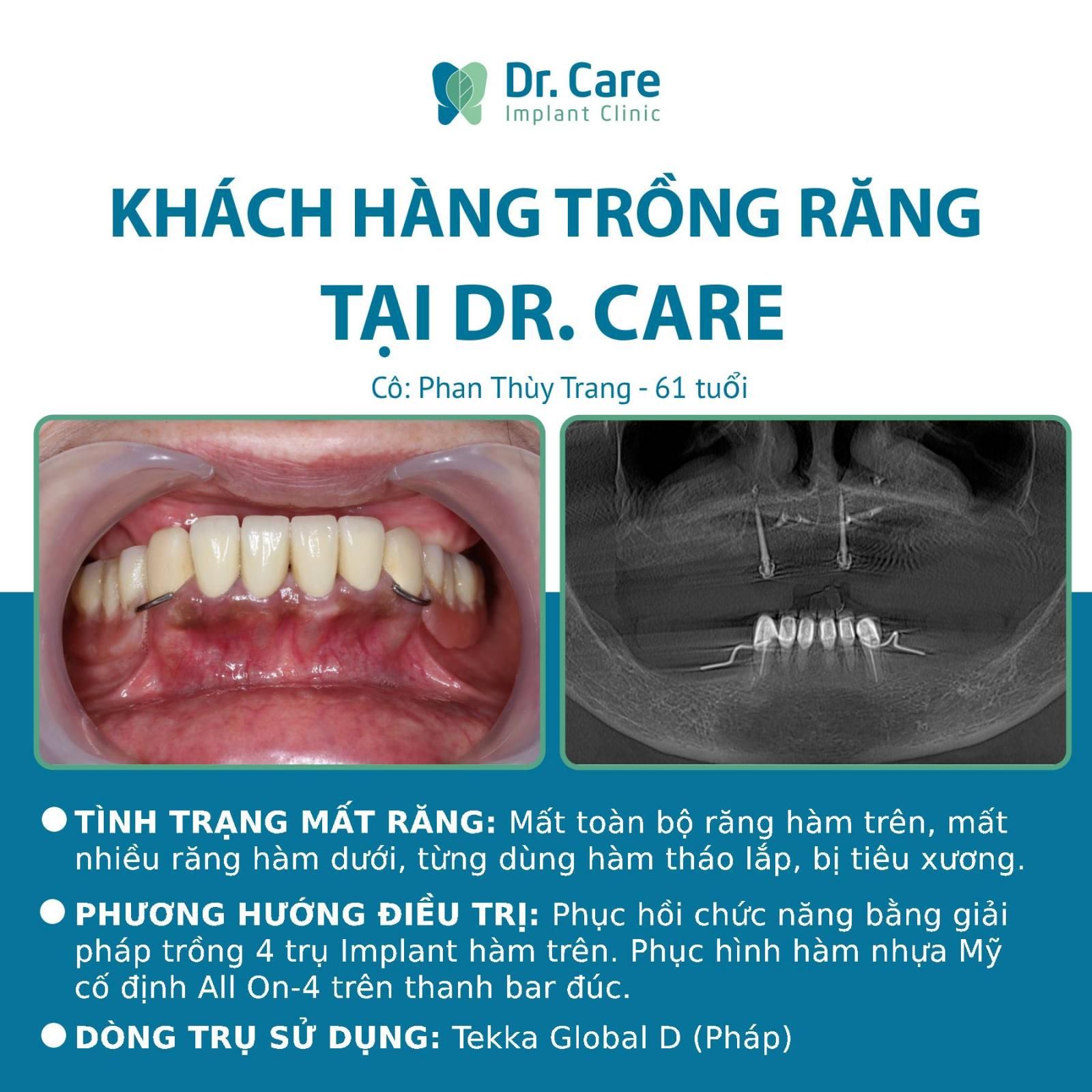 Nhật ký trồng răng Implant