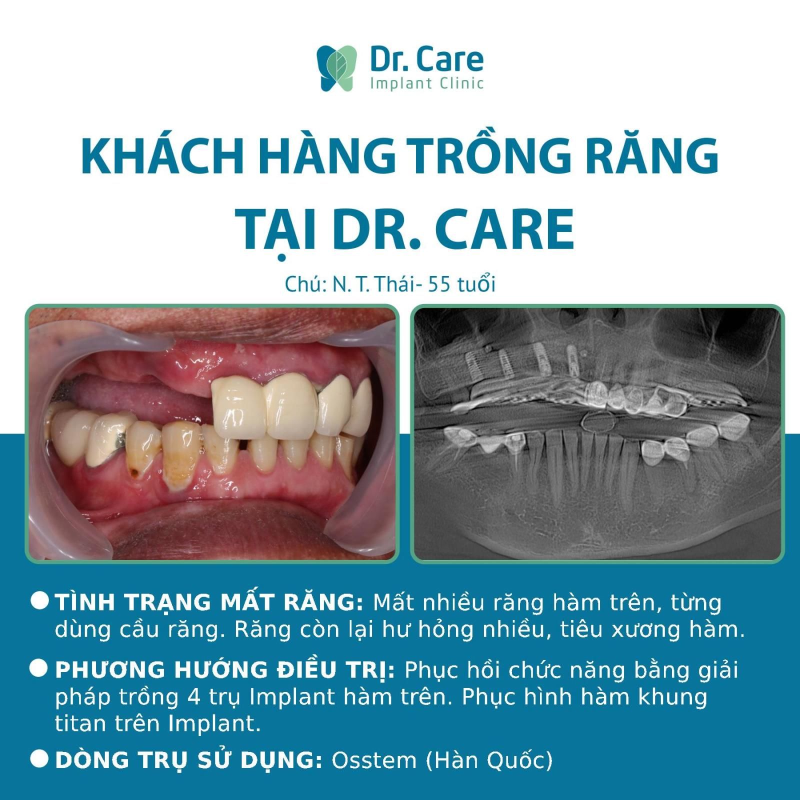 Nhật ký trồng răng Implant