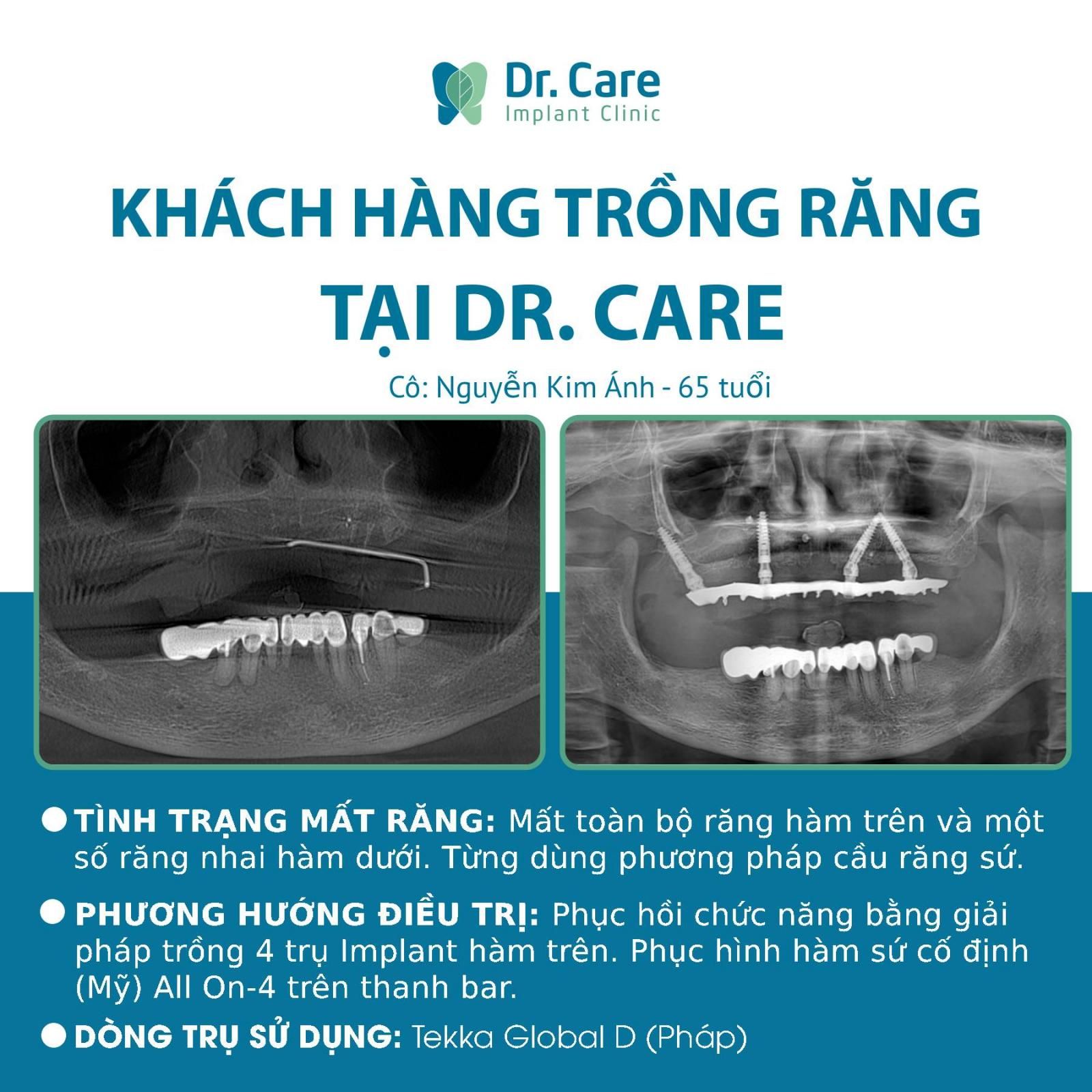 Nhật ký trồng răng Implant