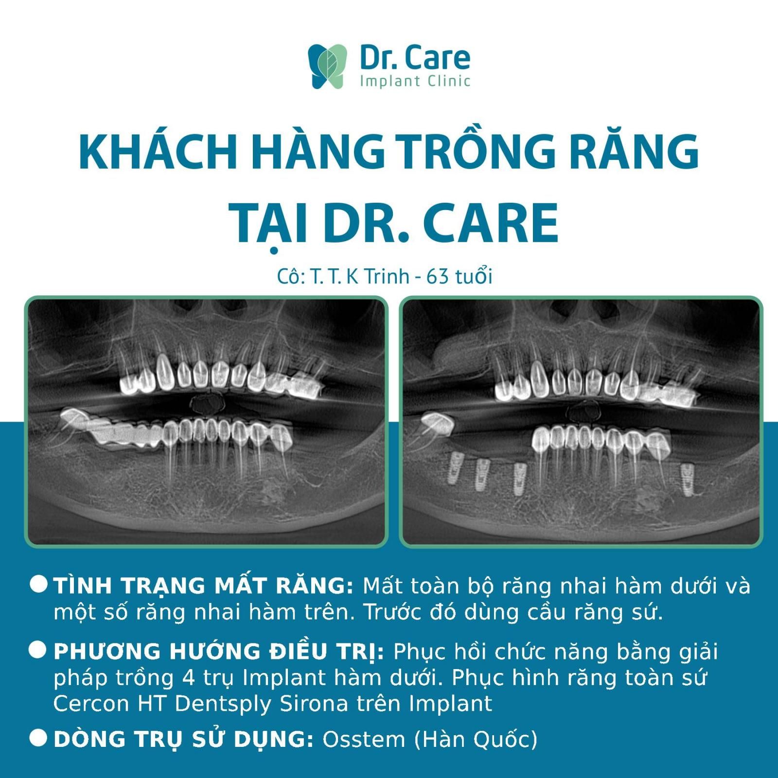 Nhật ký trồng răng Implant