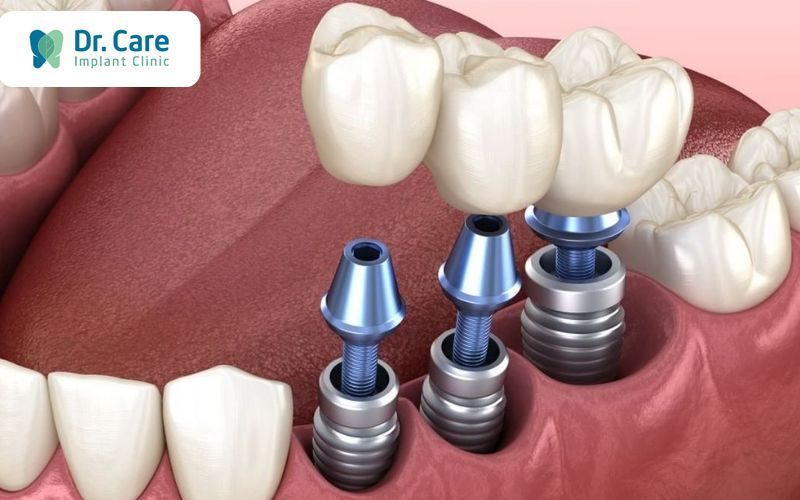 Trồng lại răng Implant sau khi niềng răng 