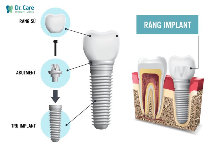 Cấu tạo của răng Implant