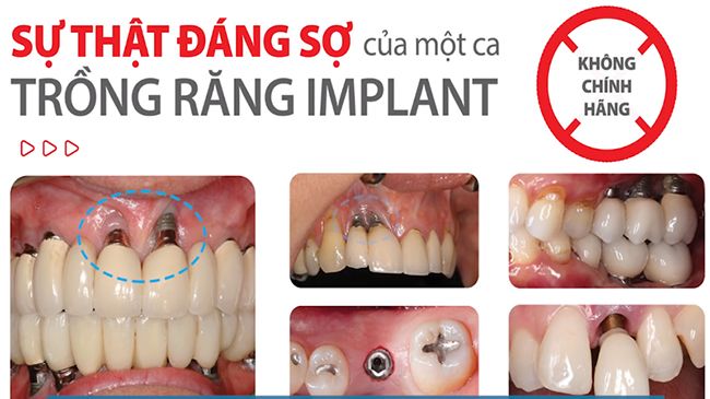 biến chứng có thể xảy ra trong quá trình cấy ghép Implant