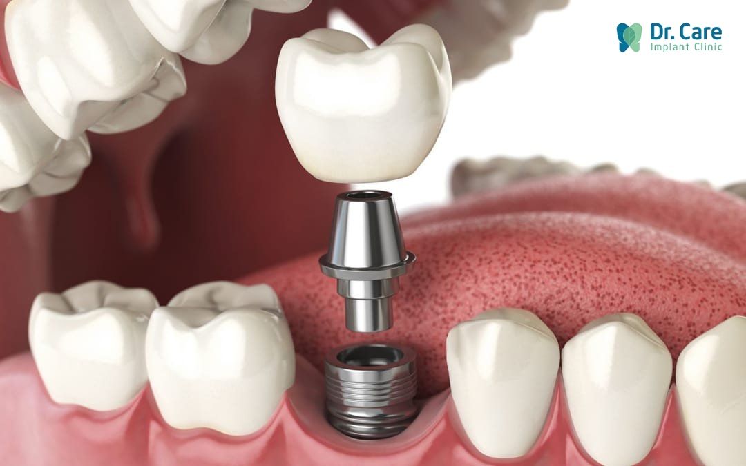 Đối tượng không nên cấy ghép Implant