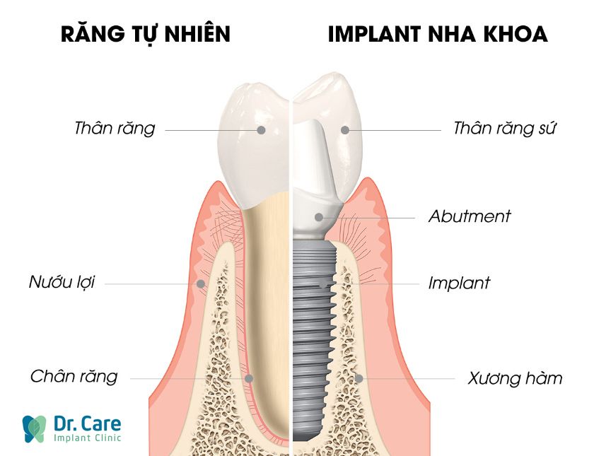 Cấy ghép Implant có tốt không?