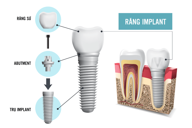 trồng răng Implant