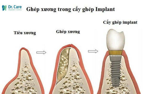 Tại sao tiêu xương răng phải ghép xương mới trồng được răng Implant?