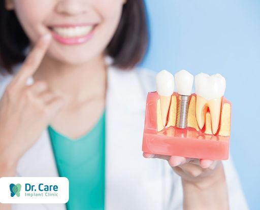 Cách chăm sóc răng sứ sau khi phục hình trên Implant 