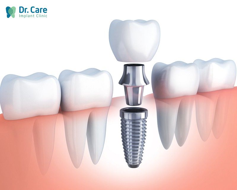 Răng sứ trên Implant có thể thay thế được không?