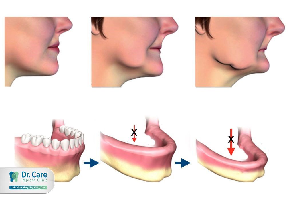 Làm cầu răng sứ bao lâu thì xương hàm bị tiêu đi?