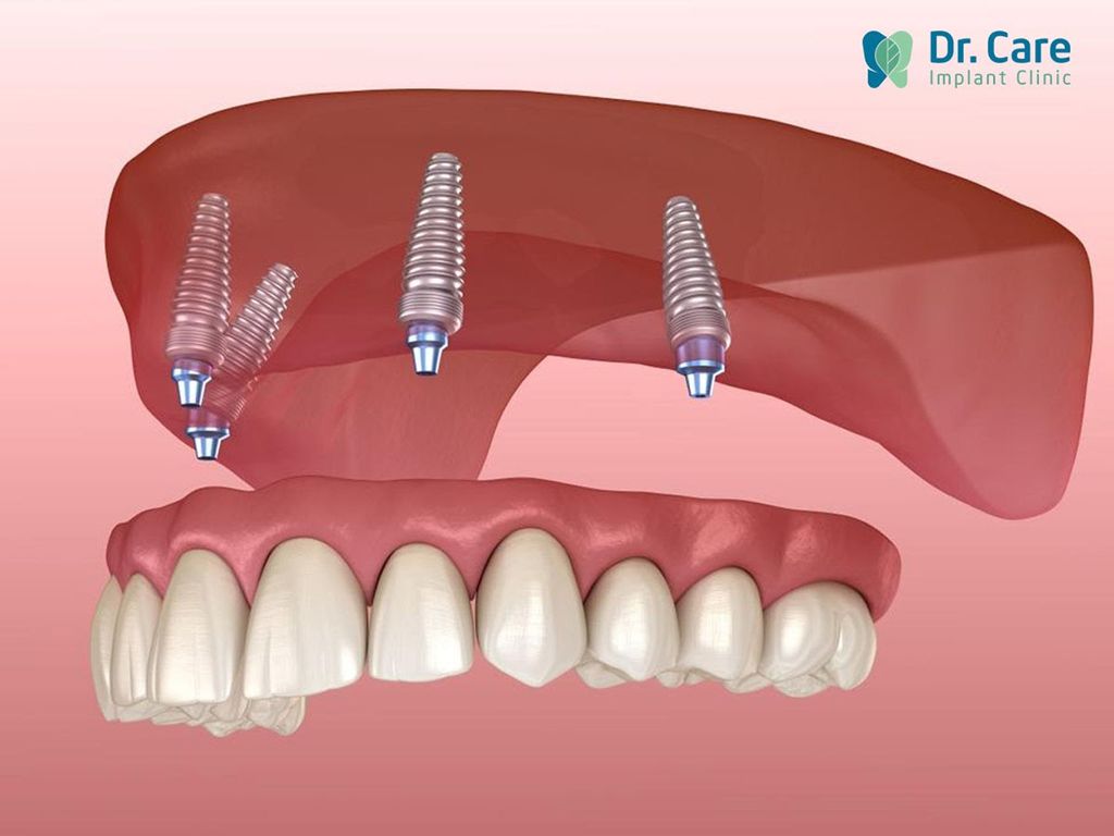 Trồng răng Implant có chụp MRI được không?