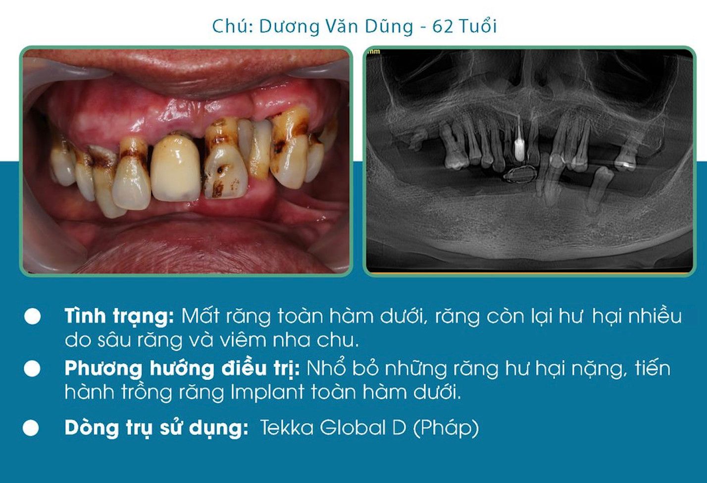 Viêm nha chu - mất răng có cấy ghép Implant được không?