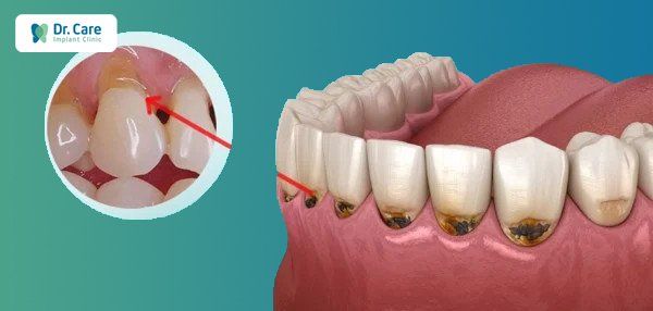 Hậu quả nghiêm trọng khi bị mục chân răng