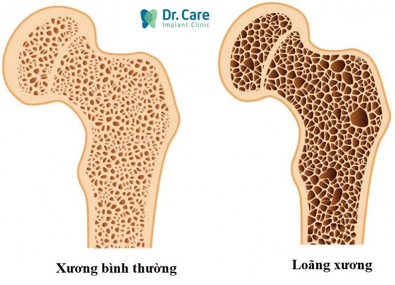 Bệnh loãng xương là gì?