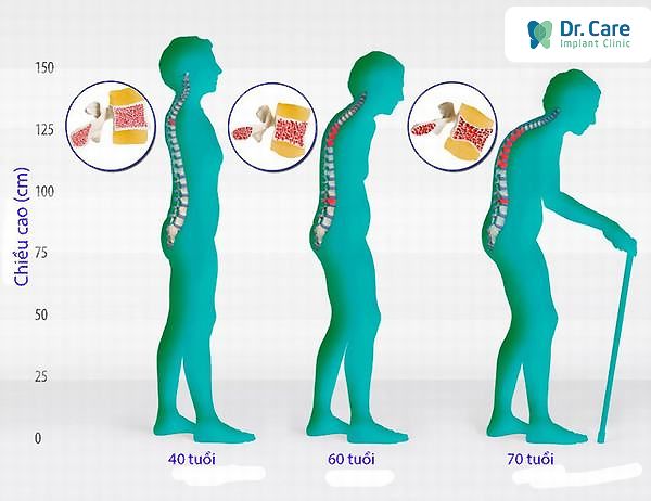 Nguyên nhân dẫn đến bệnh loãng xương