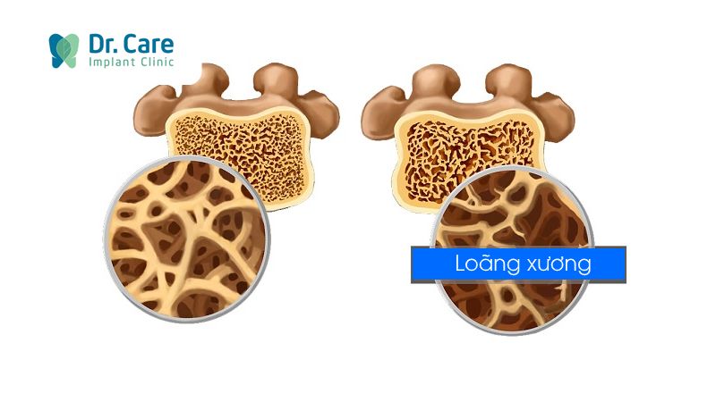 Trồng răng Implant khi bị loãng xương có dễ thất bại không? 