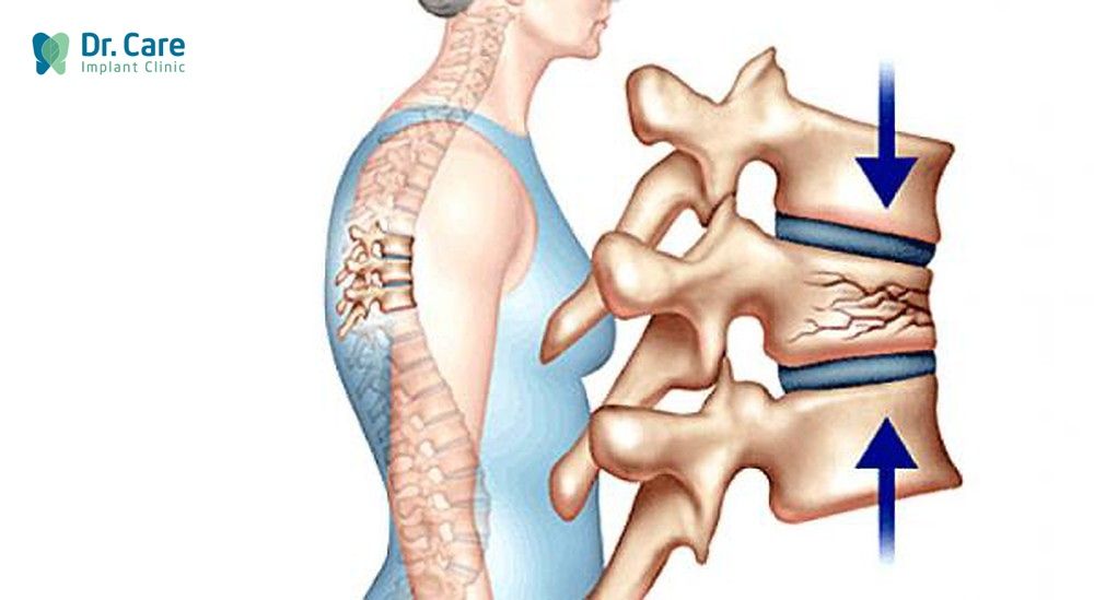 Bệnh loãng xương ảnh hưởng thế nào đến chất lượng cuộc sống?