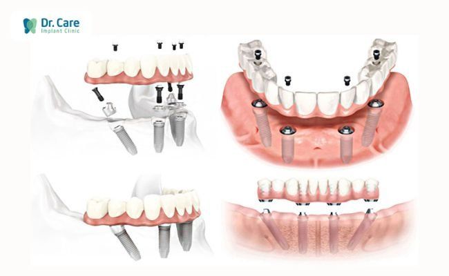 Răng giả tháo lắp loại nào tốt nhất hiện nay?