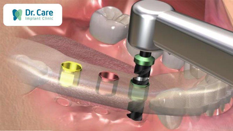 Quy trình trồng răng Implant không đau tại Nha khoa Dr. Care