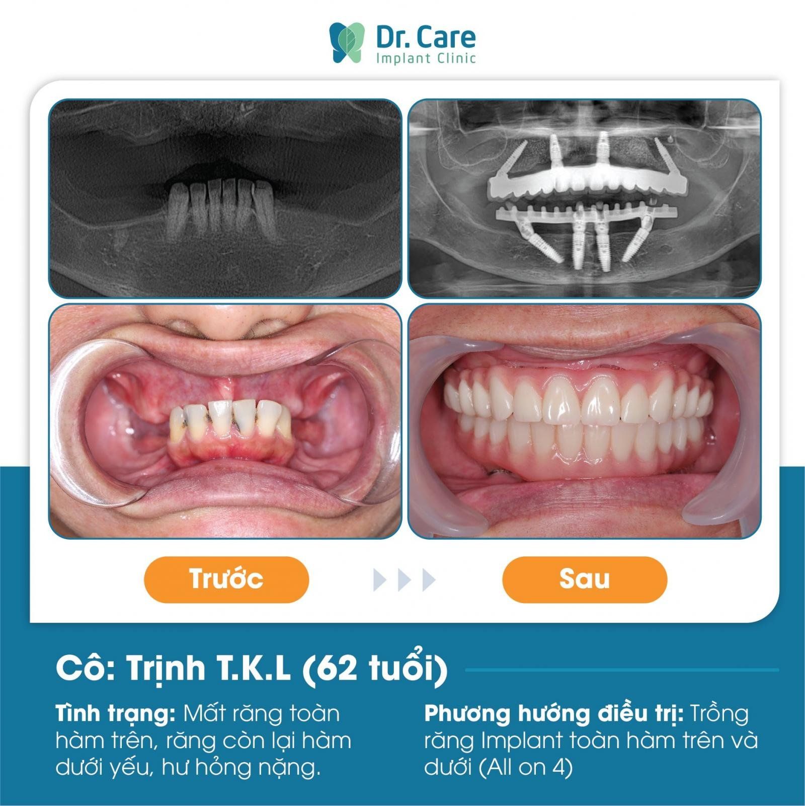 Quy trình trồng răng Implant không đau tại Nha khoa Dr. Care