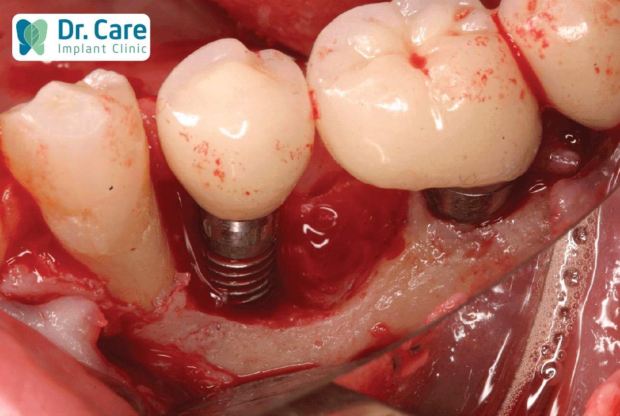 Chảy máu nhiều nguy cơ đào thải trụ Implant