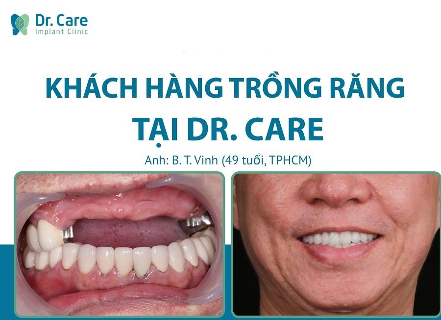 Sau 3-6 tháng trụ Implant sẽ lành thương