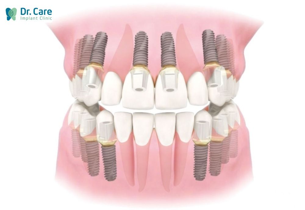 Cấy nhiều trụ Implant cùng lúc gây đau đớn hơn so với cắm chỉ 1 trụ.