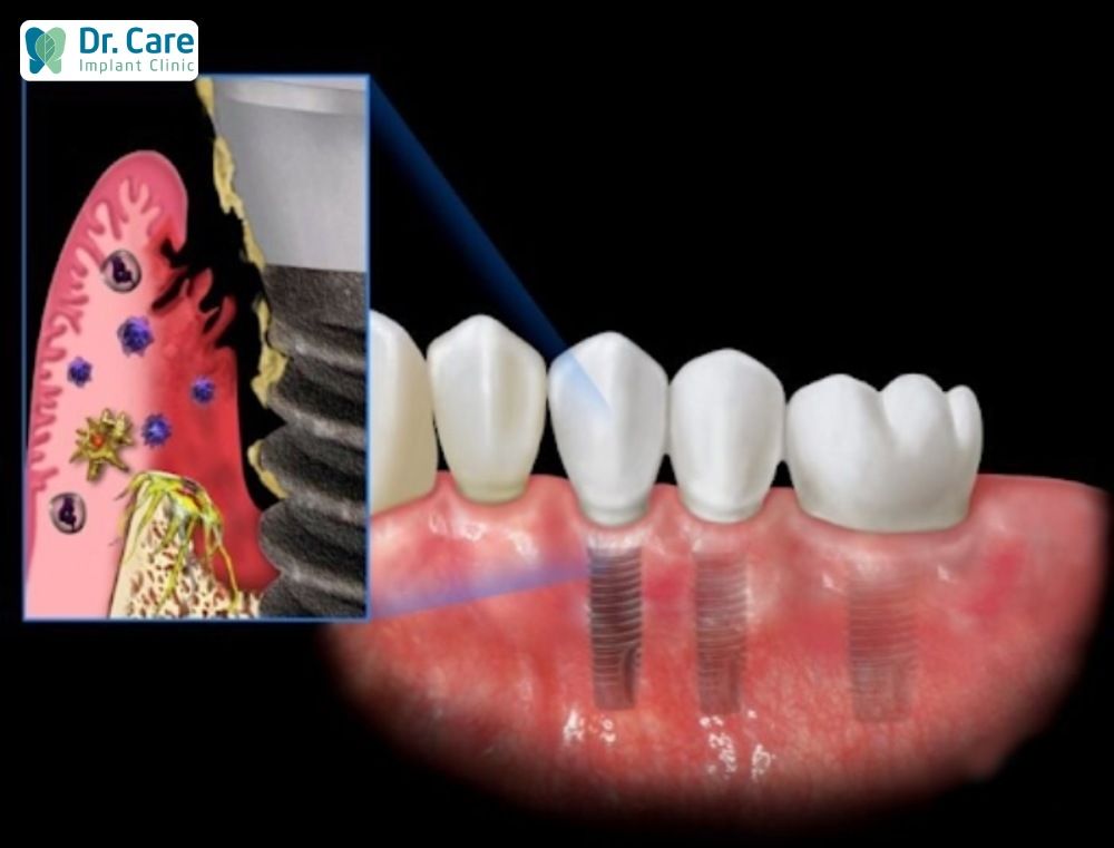 Nguy cơ cao đào thải trụ Implant nếu không được thực hiện đúng kỹ thuật.