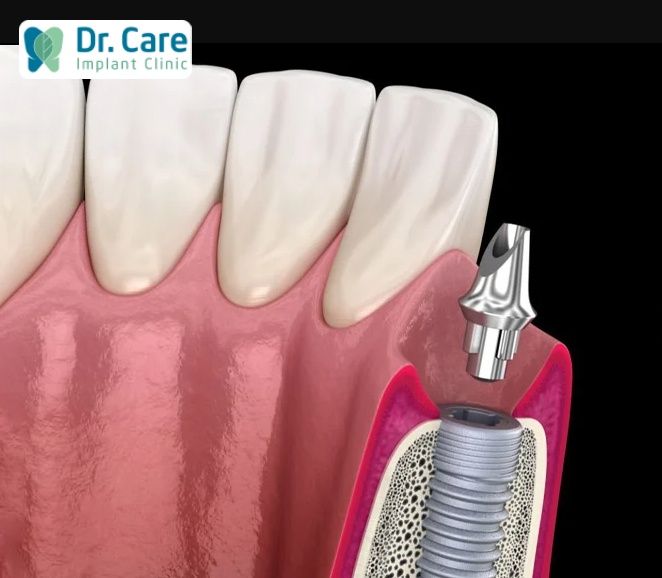 abutment phù hợp với nhiều trường hợp