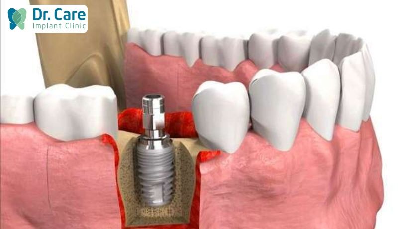 Cấu tạo trụ Implant được làm từ Titanium nguyên chất