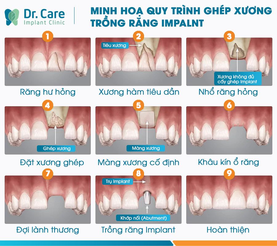 Giai đoạn ghép xương khá quan trọng, trung bình khoảng 6 tháng sẽ lành thương