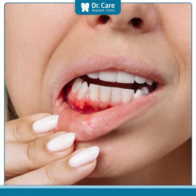 Chảy máu chân răng là dấu hiệu của ung thư