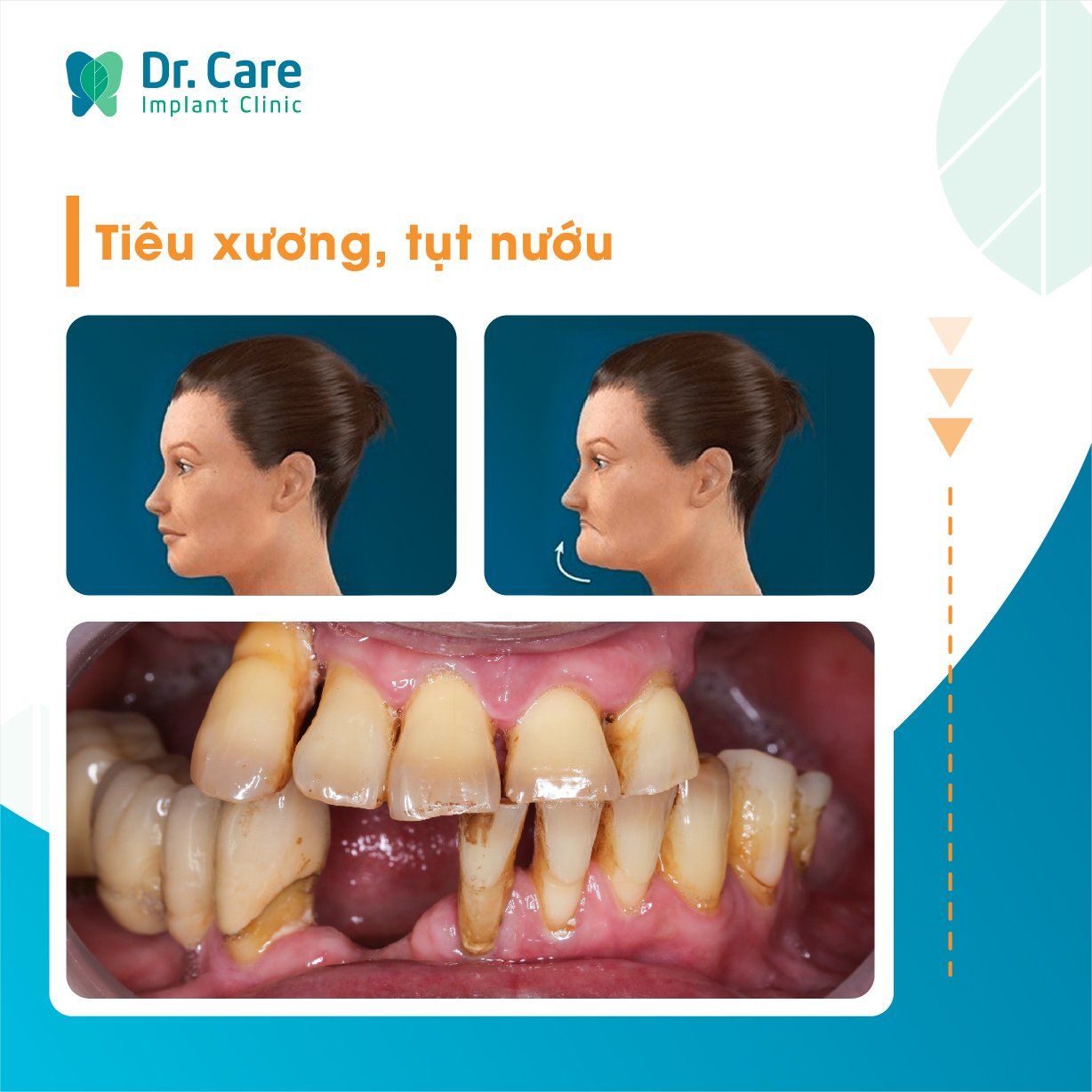 trồng răng implant