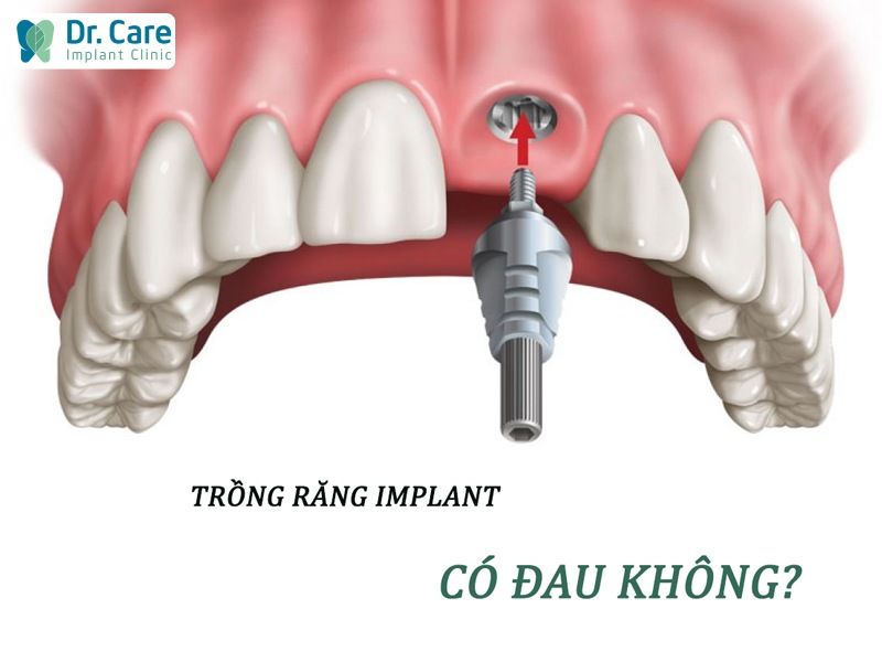 Việc sưng đau nhẹ sau khi trồng răng là hoàn toàn bình thường