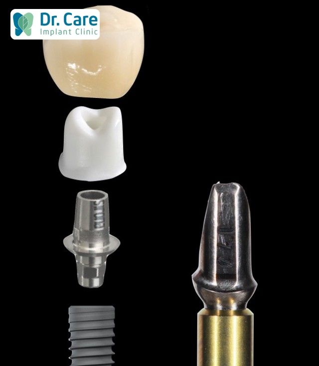 Custom Abutment có ảnh hưởng đến quá trình điều chỉnh hàm răng không?