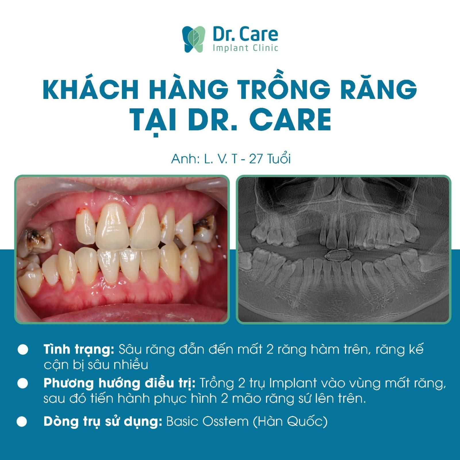 Trồng răng bằng trụ Implant Hàn Quốc mang lại thẩm mỹ cao