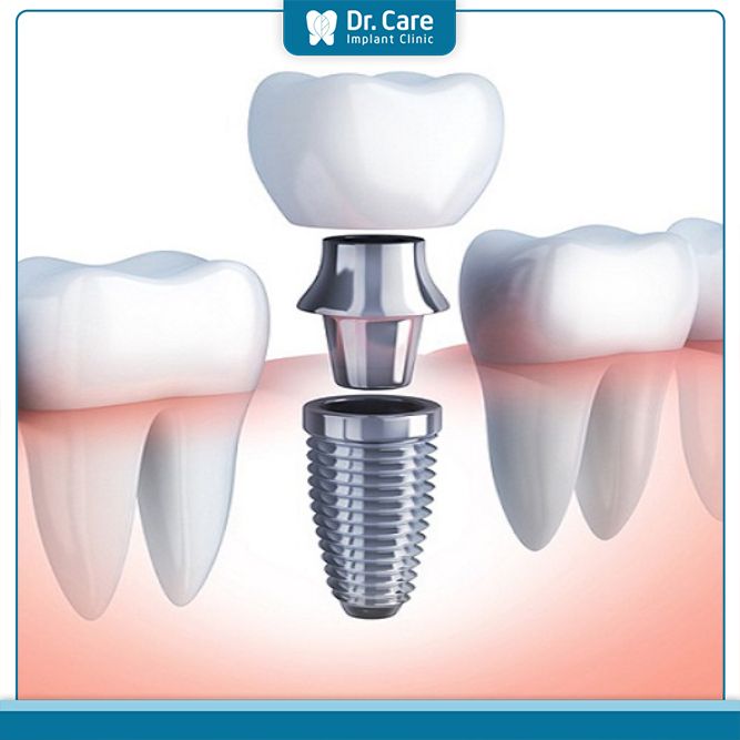 Implant là phương pháp khắc phục răng lệch hiệu quả